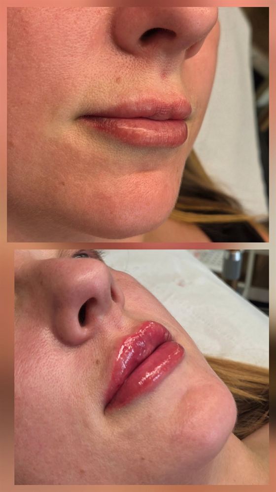Glossy, natural lip filler result at Queens Aesthetics, Chesterfield
